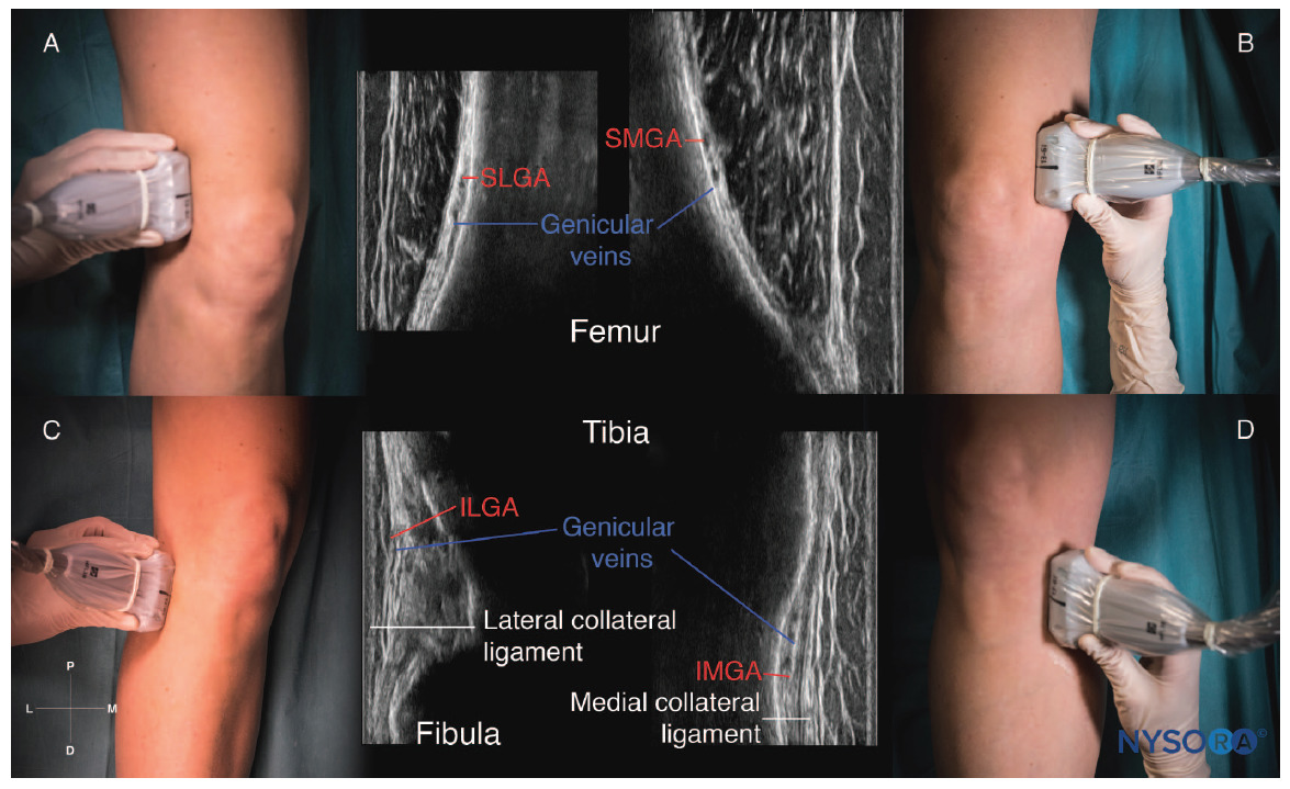genicular ultrassom BLOQUEIO DE NERVOS GENICULARES COM ULTRASSOM
