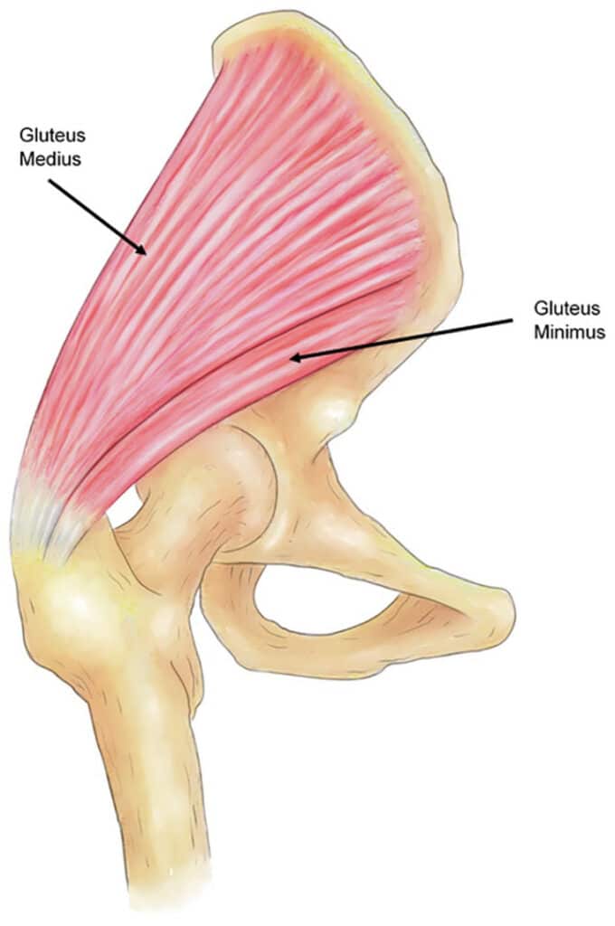 Tendinopatia glútea do quadril Tendinopatia glútea