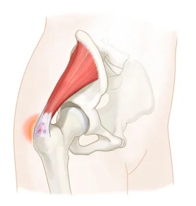Tendinopatia glútea medio