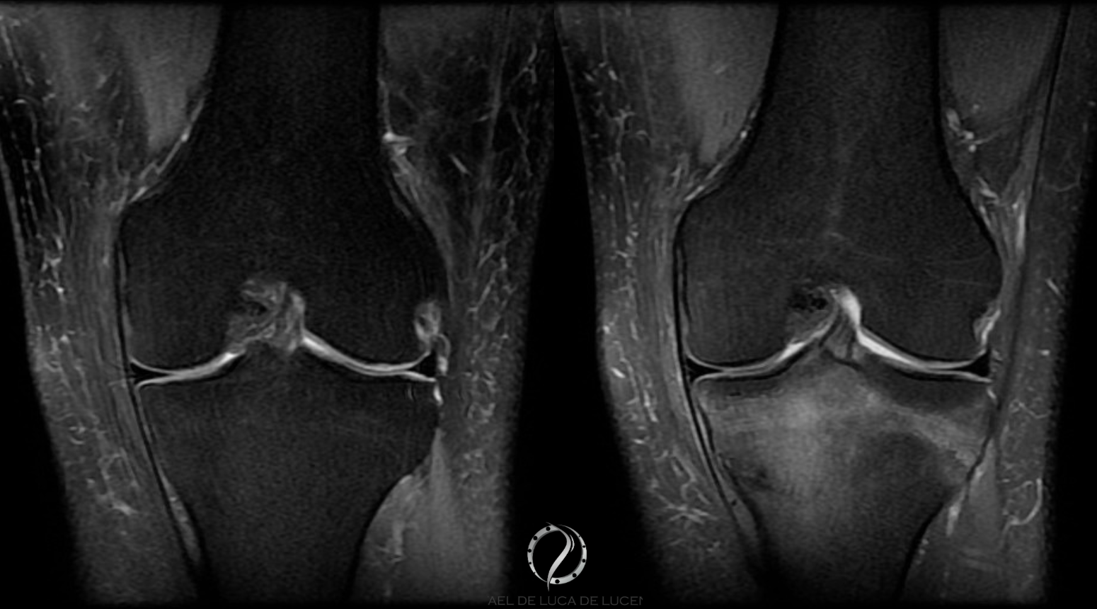 fratura estresse do joelho - imagem com edema ósseo na ressonancia magnetica fratura estresse do joelho