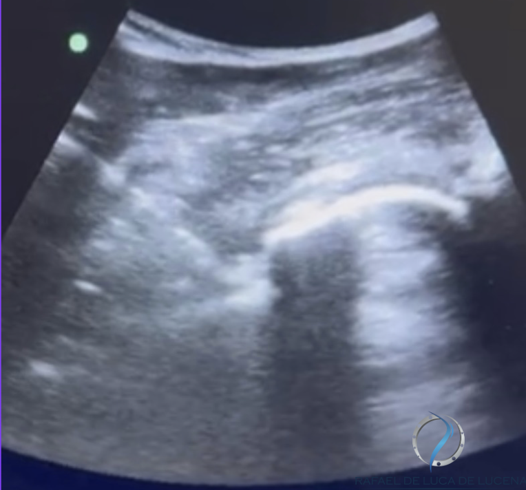 infiltracao de quadril por ultrassom