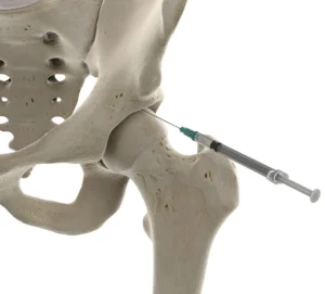 Infiltração no Quadril