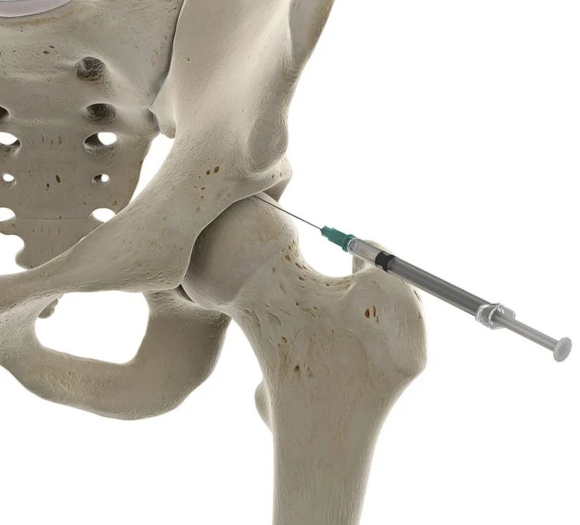 Infiltração no Quadril