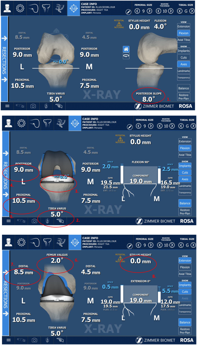 Prótese de Joelho Robótica 1 cirurgia robótica de joelho em porto alegre
