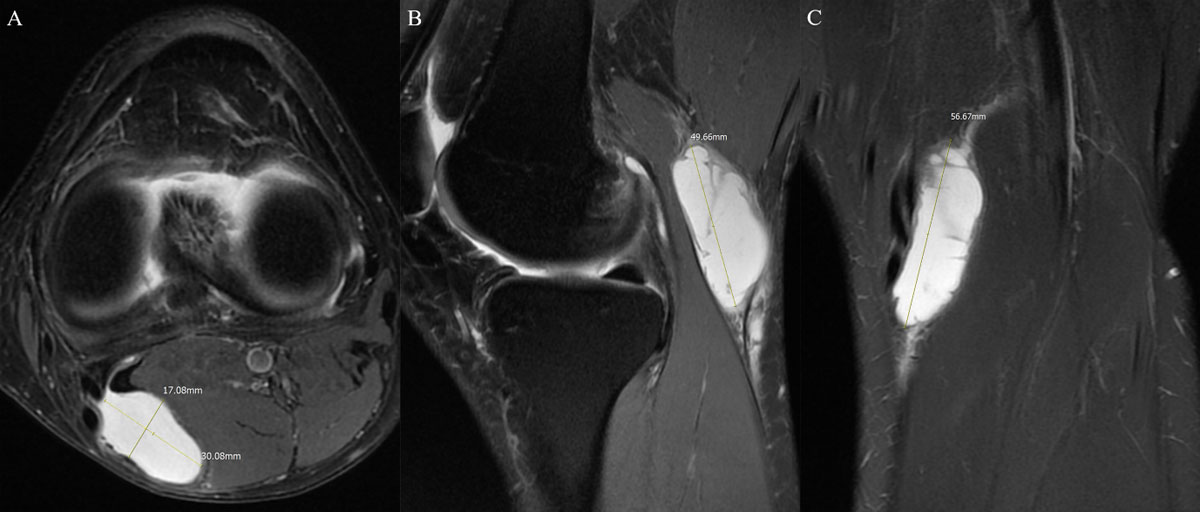 cisto baker mri cisto baker mri