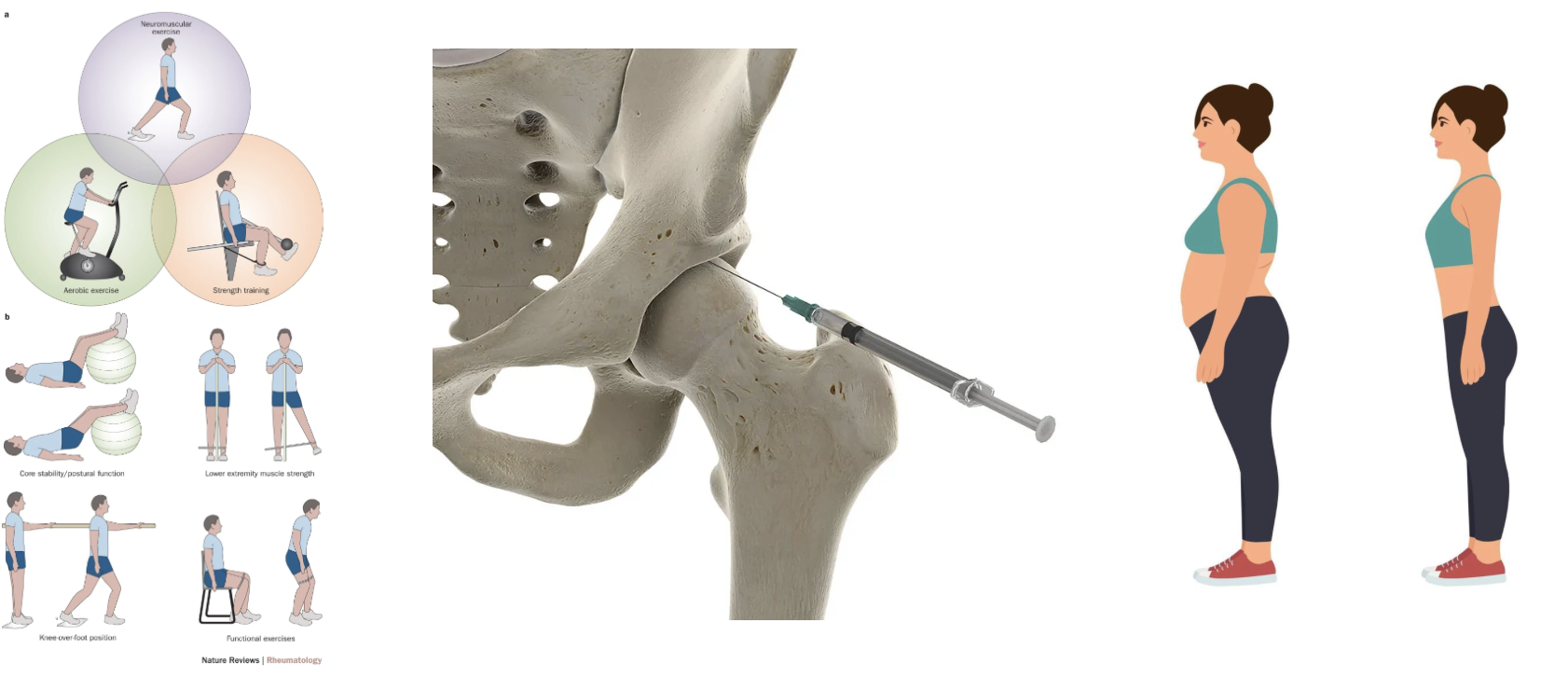 Prótese Total de Quadril 1 Tratamento conservador do quadril