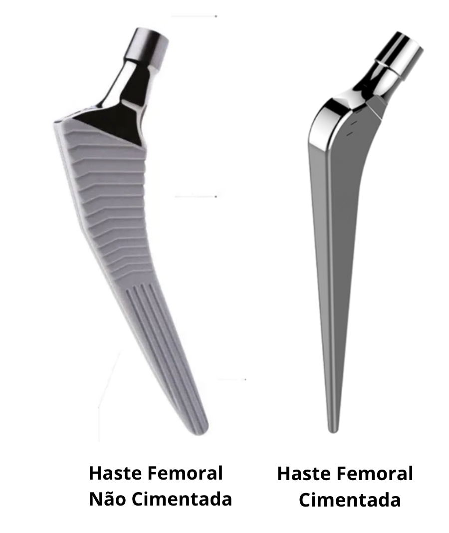 Prótese Total de Quadril 3 haste femoral cimentada e nao cimentada