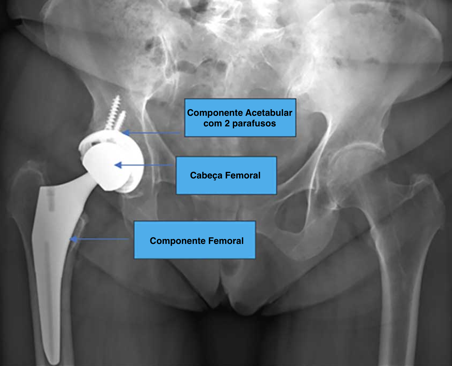 Prótese Total de Quadril 8 Captura de Tela 2026 03 26 as 17.30.21
