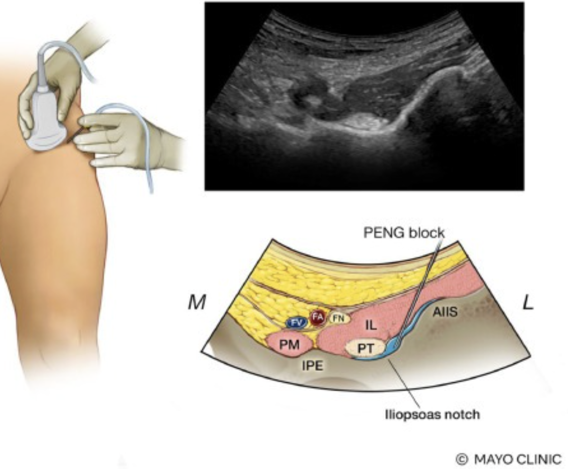 Artrose do Quadril 5 peng block quadril