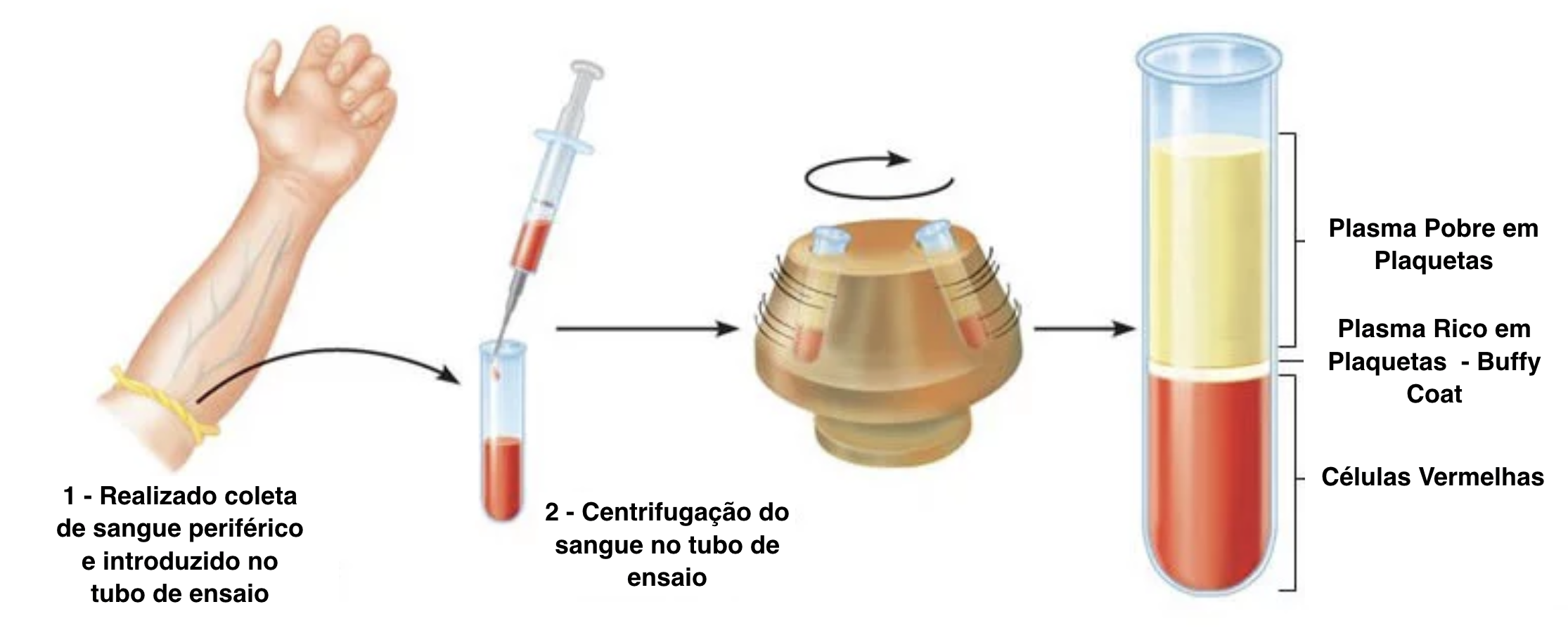 PRP - Plasma Rico em Plaquetas 1 PRP - Plasma rico em plaquetas