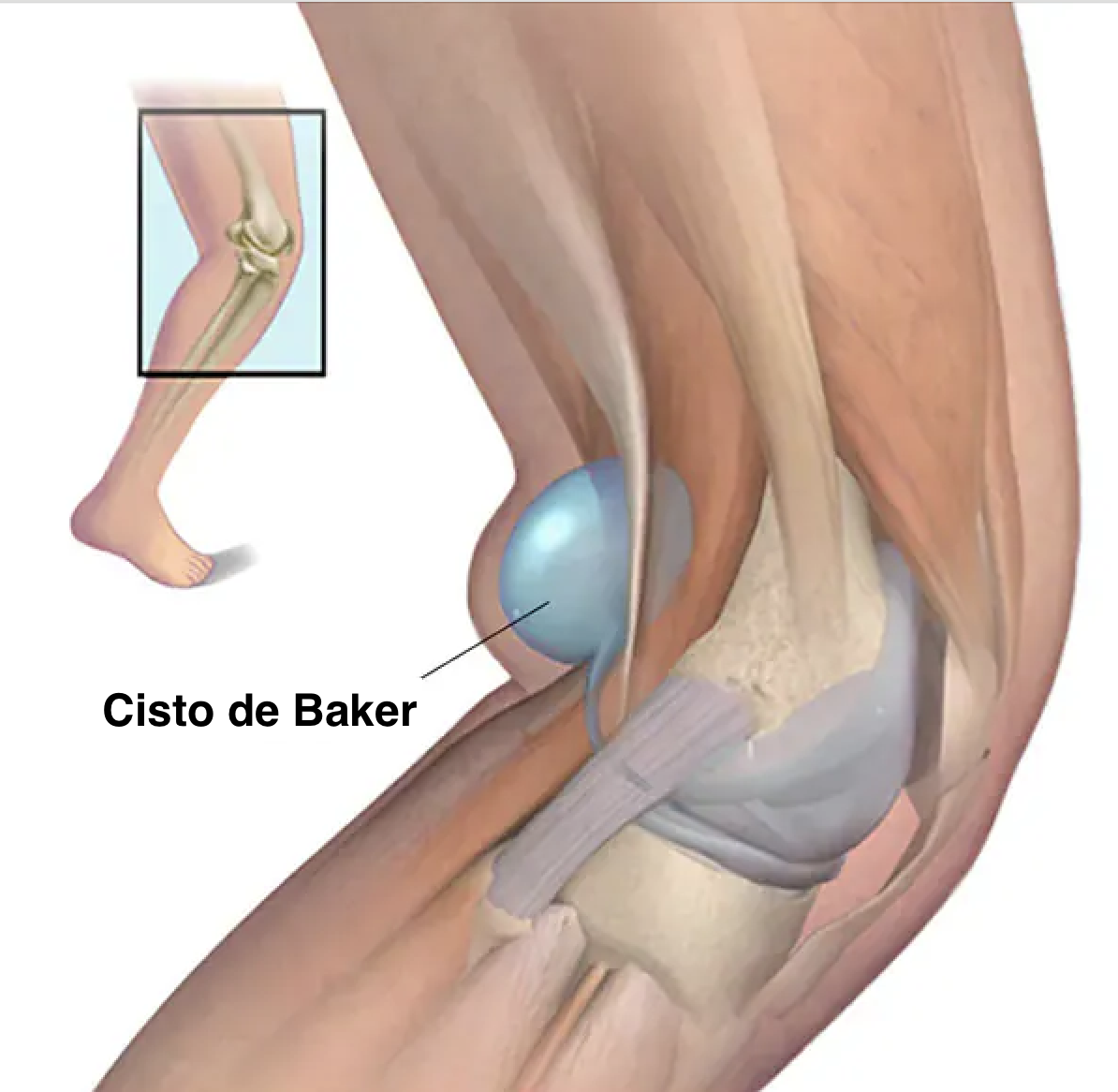 cisto de baker sintomas cisto de baker sintomas