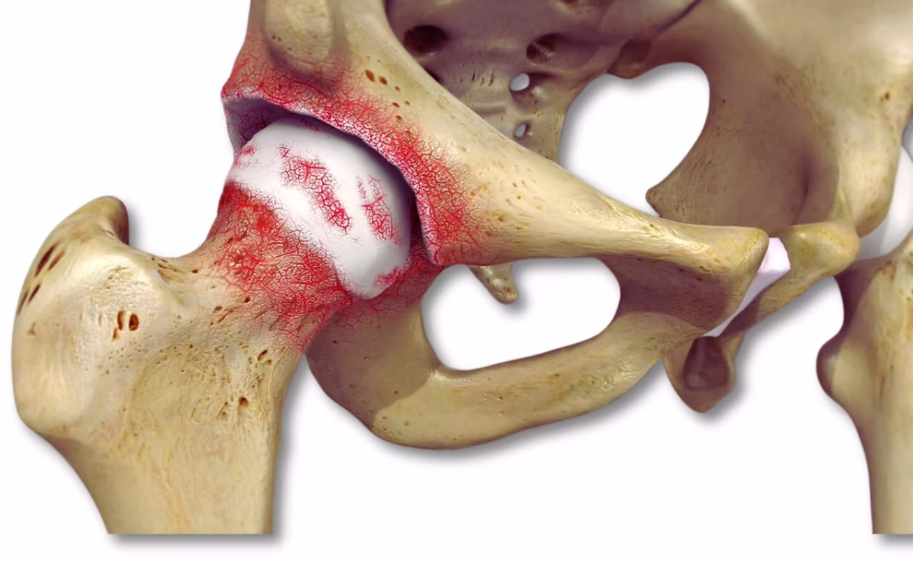 Artrose de Quadril Porto Alegre e Gravatai Artrose de Quadril Porto Alegre e Gravatai