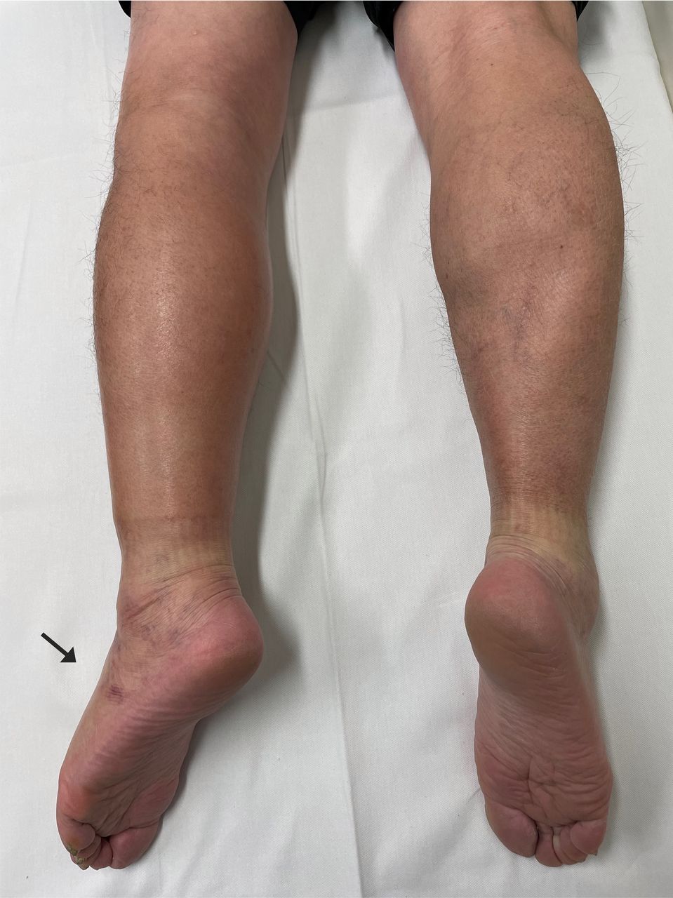 cisto baker rompido cisto baker rompido