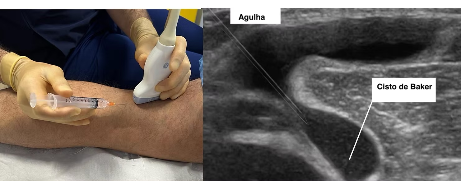 cisto baker aspiração cisto baker aspiração