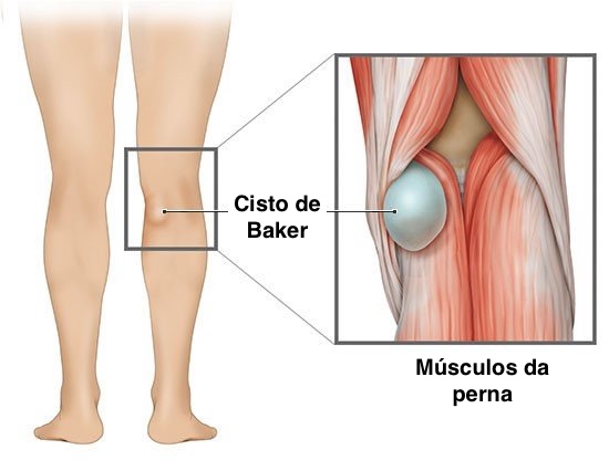 Home 10 cisto de baker