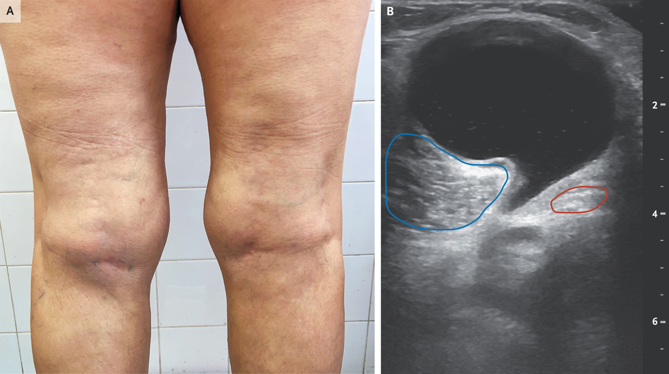 Cisto de Baker 1 Pernas com inchaço e exame de ultrassom