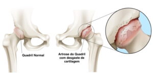 artrose do quadril