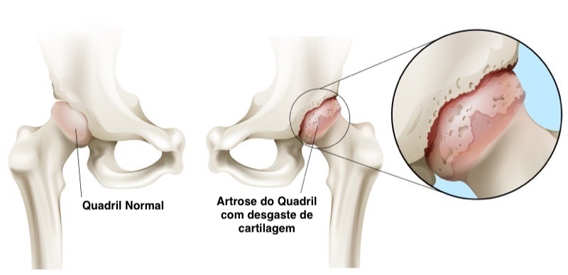 artrose do quadril